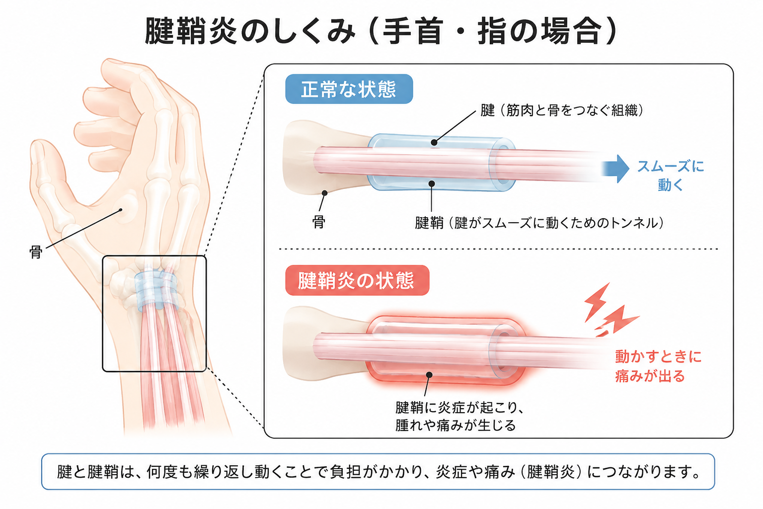 腱鞘炎の腱と腱鞘の仕組み